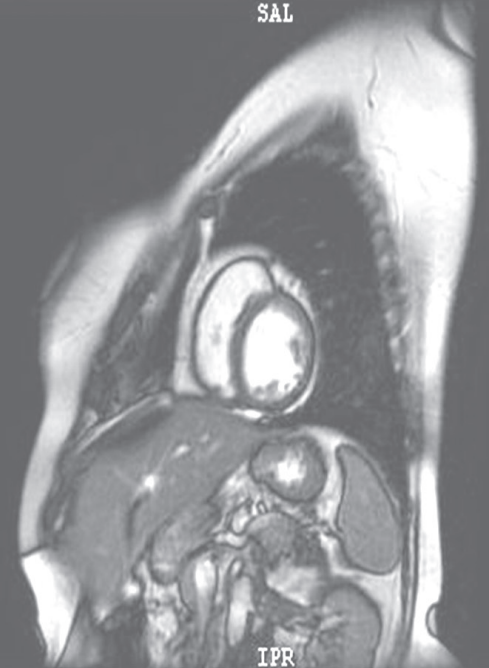 扩张型心肌病补硒（扩张型心肌病新药）-硒宝网