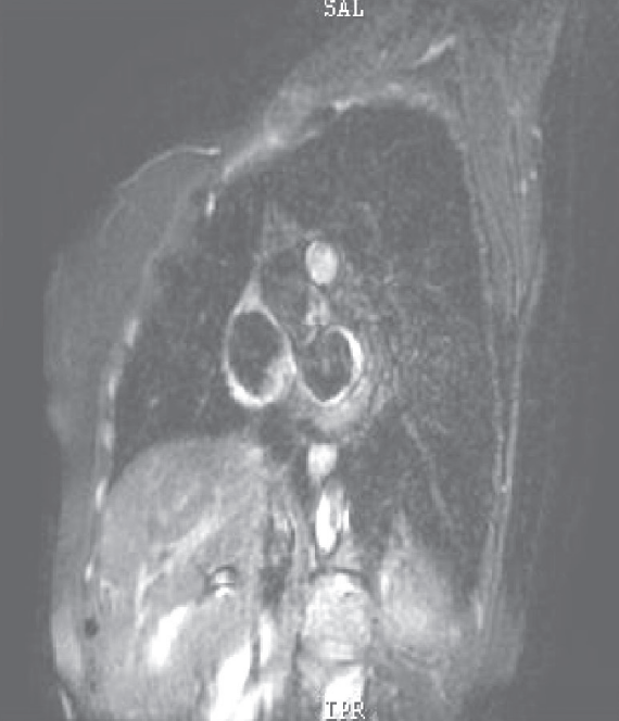 扩张型心肌病补硒（扩张型心肌病新药）-硒宝网