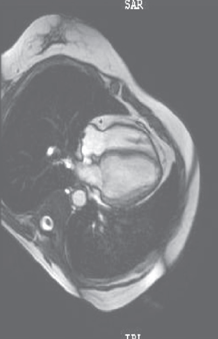 扩张型心肌病补硒（扩张型心肌病新药）-硒宝网