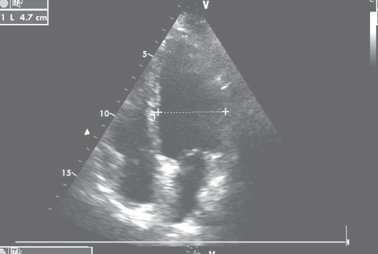 扩张型心肌病补硒（扩张型心肌病新药）-硒宝网