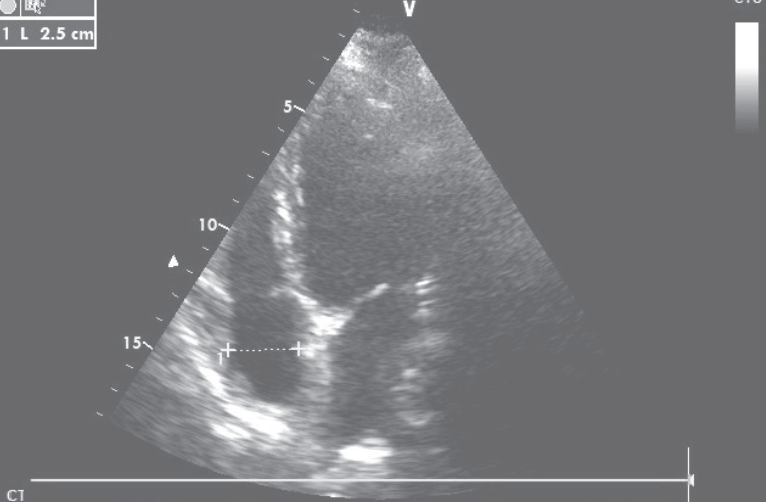 扩张型心肌病补硒（扩张型心肌病新药）-硒宝网