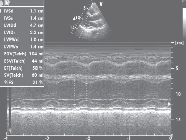 扩张型心肌病补硒（扩张型心肌病新药）-硒宝网