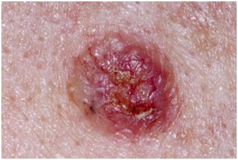 糖尿病胆囊癌补硒(胆囊癌补硒可以嘛)-硒宝网