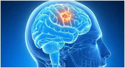 糖尿病胆囊癌补硒(胆囊癌补硒可以嘛)-硒宝网