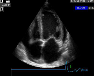 扩张型心肌病补硒(扩张病补心肌型硒有用吗)-硒宝网