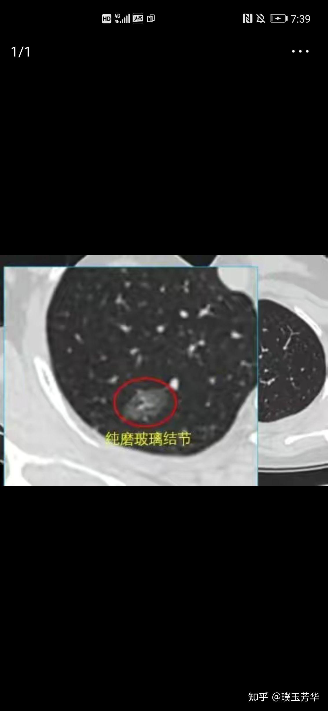 补硒对慢型克山?。ㄎ钥松讲〉淖饔茫?硒宝网