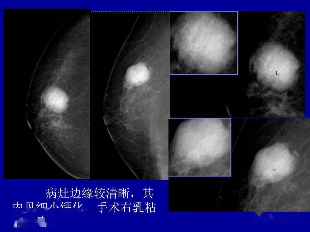 补硒对慢型克山?。ㄎ钥松讲〉淖饔茫?硒宝网