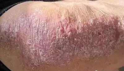 银屑病患者补硒吗（硒缺乏银屑?。?硒宝网