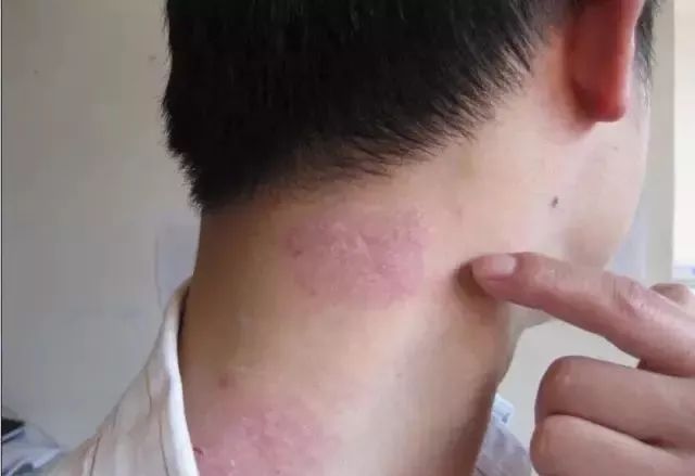 银屑病患者补硒吗（硒缺乏银屑?。?硒宝网