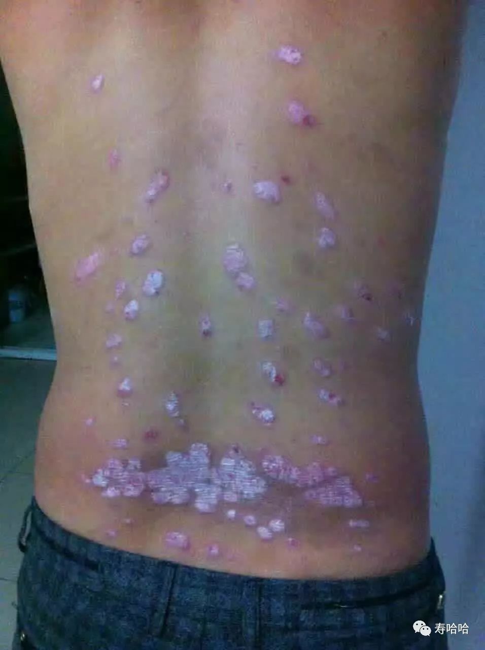 银屑病患者补硒吗（硒缺乏银屑?。?硒宝网