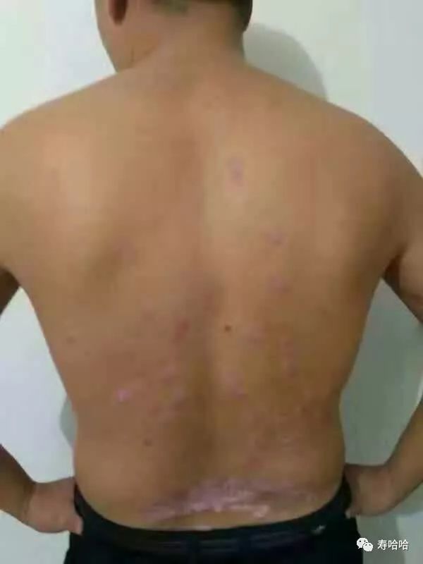 银屑病患者补硒吗（硒缺乏银屑?。?硒宝网