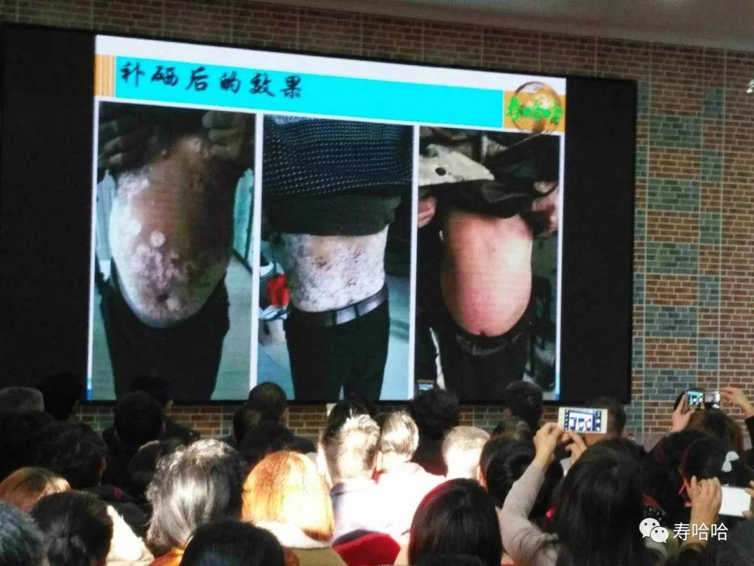 银屑病患者补硒吗（硒缺乏银屑?。?硒宝网