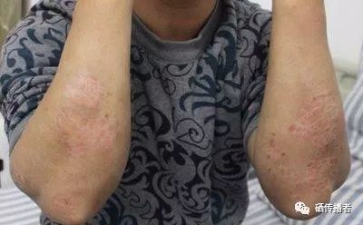 银屑病患者补硒吗（补硒治疗银屑病最好）-硒宝网