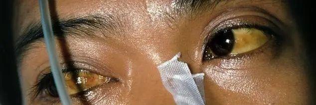 硒麦芽五子粉补肝（肝炎可以吃硒麦芽五味子片吗）-硒宝网