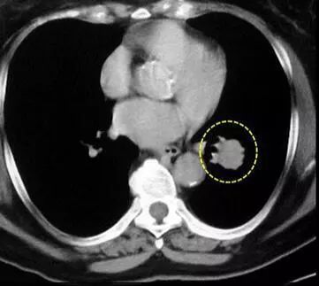肺结核病能补硒吗（肺结核可以补锌吗）-硒宝网