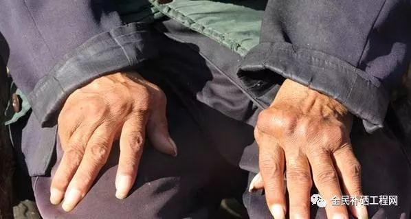 类风湿病要补硒吗(风湿病补类硒要多长时间)-硒宝网