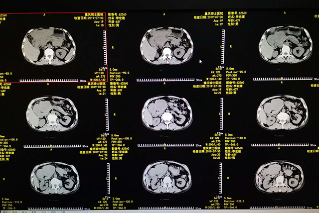 硒产品治疗食道癌（硒食道癌）-硒宝网