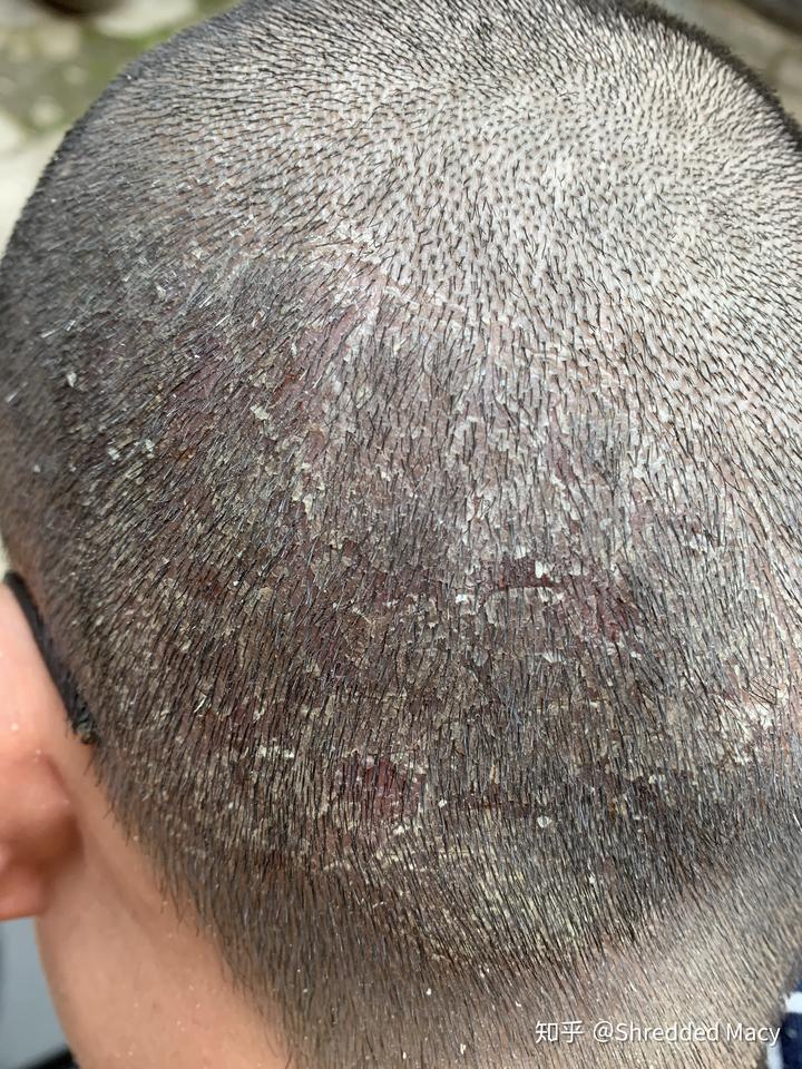 硒产品能治布病吗（硒治百病骗局）-硒宝网