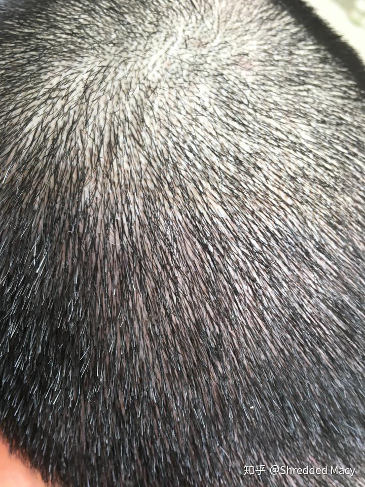 硒产品能治布病吗（硒治百病骗局）-硒宝网