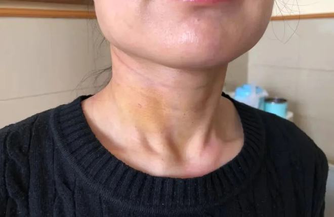 甲状腺结节硒维康(硒对甲状腺结节的作用)-硒宝网