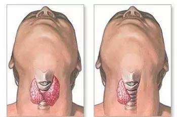 甲状腺结节硒维康(硒对甲状腺结节的作用)-硒宝网