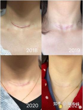 癌症术后吃硒维康(癌症术吃硒维康后吃什么好)-硒宝网