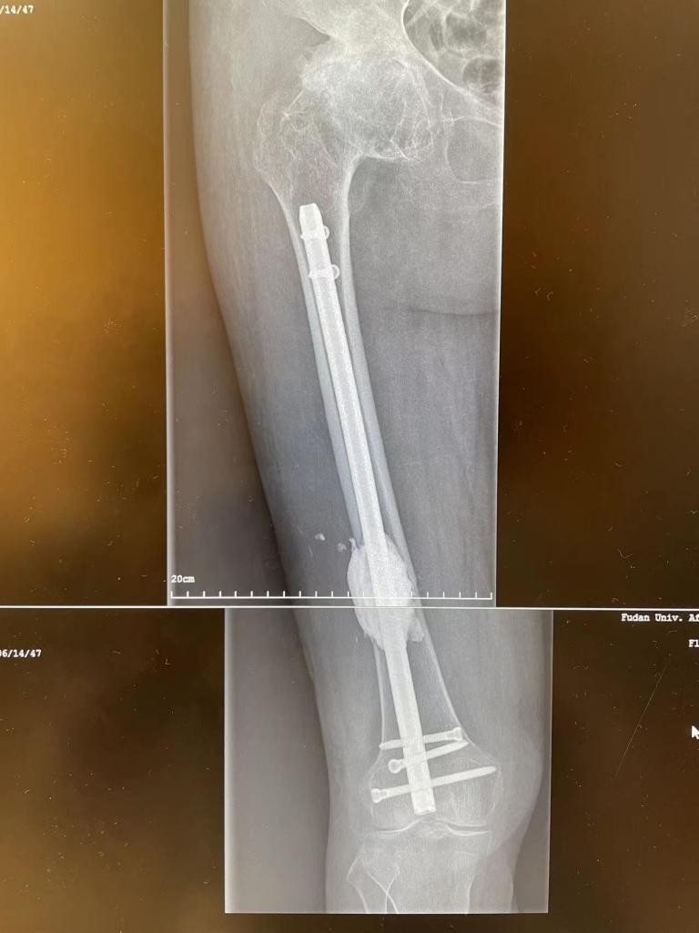 骨折补钙(骨折补钙的最佳时间)-硒宝网