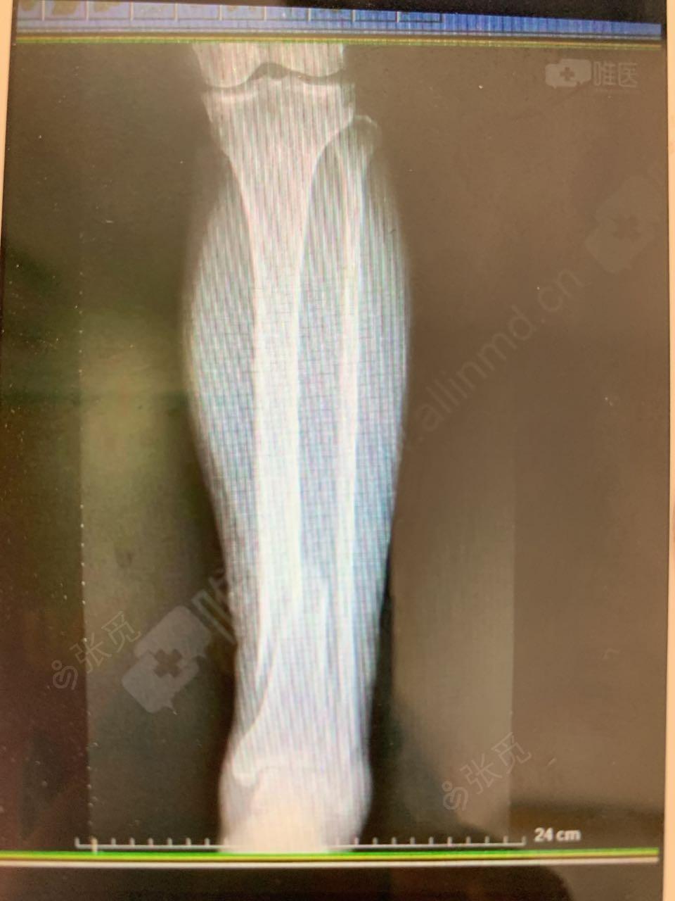 骨折补钙(骨折补钙的最佳时间)-硒宝网