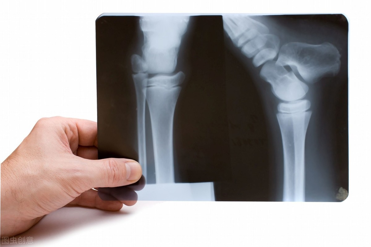 骨折补钙(骨折补钙的最佳时间)-硒宝网