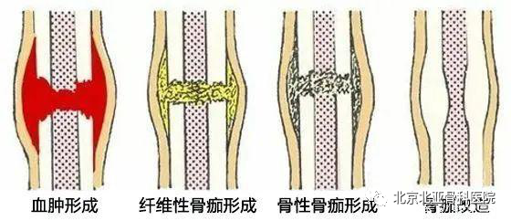 骨折补钙（骨折补钙的食物有哪些）-硒宝网