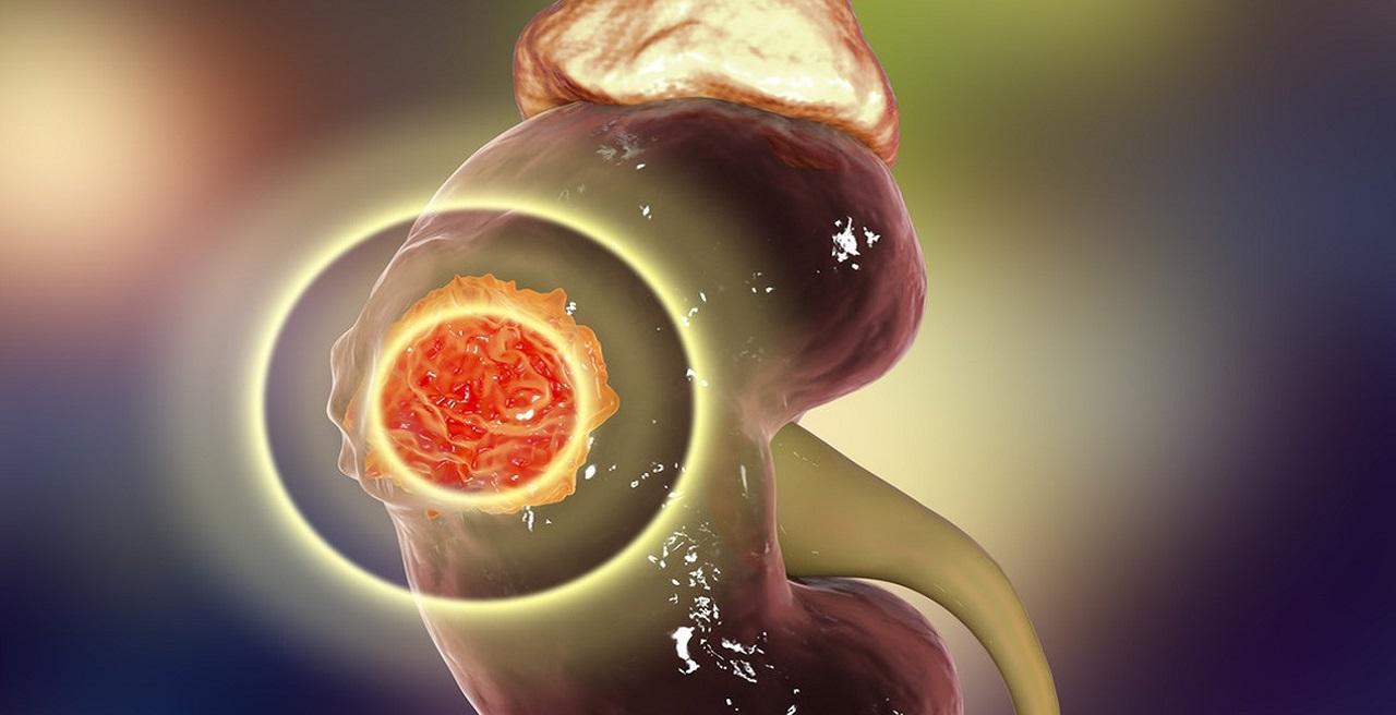 化疗吃硒维康好吗（硒维康口嚼片对化疗有作用吗）-硒宝网