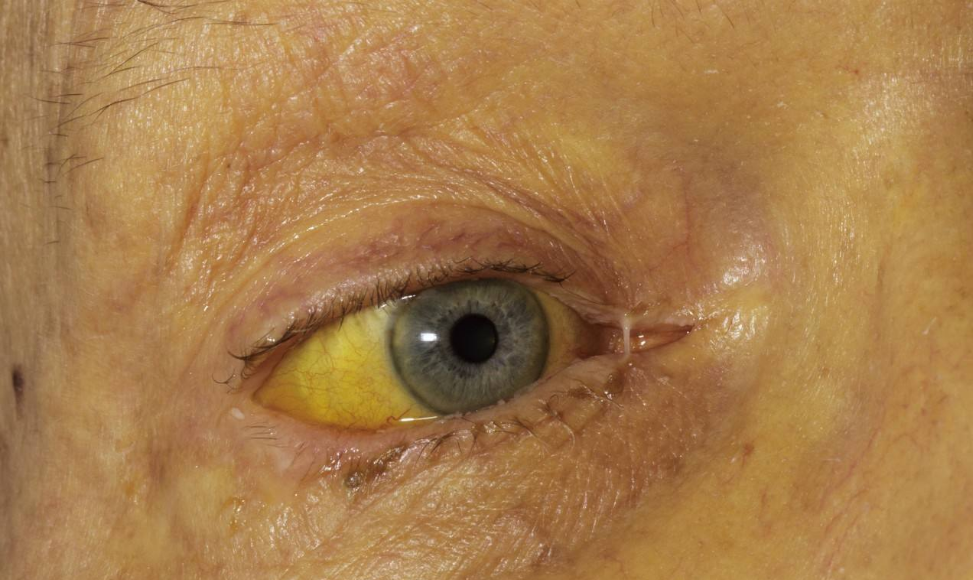 肝癌晚期吃硒维康（晚期肝癌吃硒维康好吗）-硒宝网