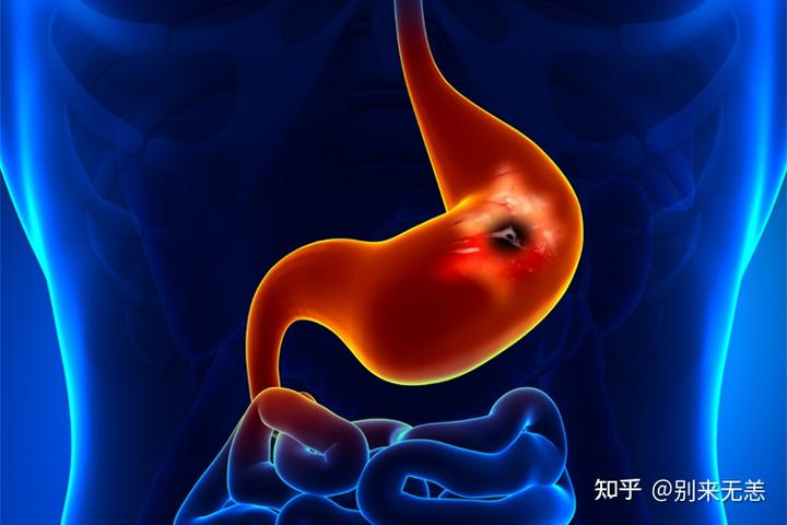 硒维康胃癌能吃么(能胃癌吃硒维康胶囊吗)-硒宝网