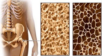 骨质疏松补钙有用吗（骨质疏松补充钙剂）-硒宝网