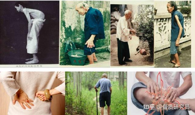 骨质疏松补钙有用吗(疏松补钙骨质用有哪些药)-硒宝网