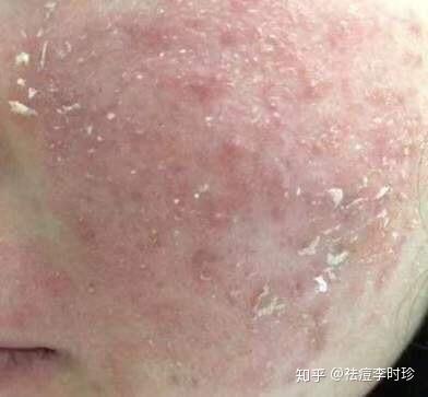 硒维康含类固醇吗(硒胆固醇)-硒宝网