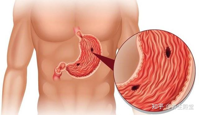 吃硒维康会胃痛吗（吃硒对胃好吗）-硒宝网
