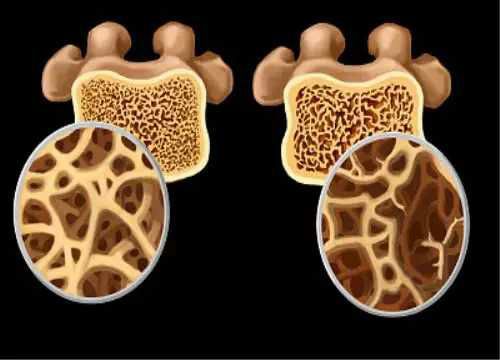 骨质增生能不能补钙(骨增生补钙有用吗)-硒宝网