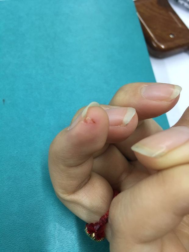 吃了锌硒宝手脱皮（脱皮补锌）-硒宝网