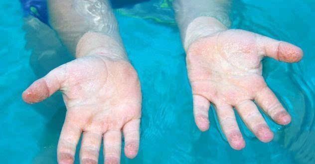 吃了锌硒宝手脱皮（脱皮补锌）-硒宝网