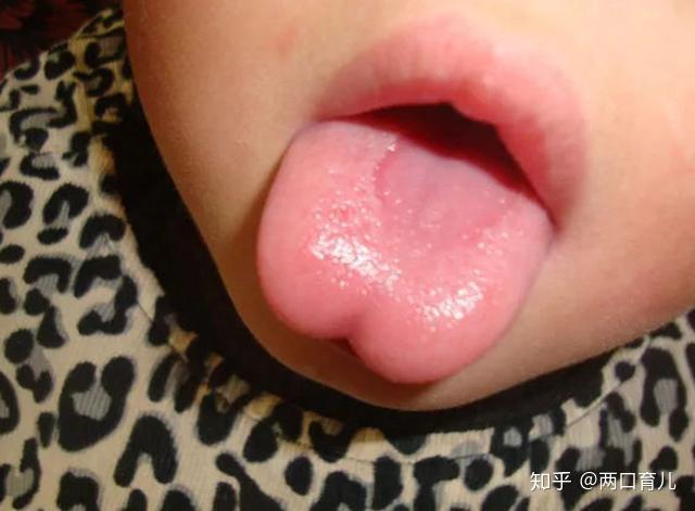 小孩缺锌吃锌硒宝(儿童缺锌硒)-硒宝网