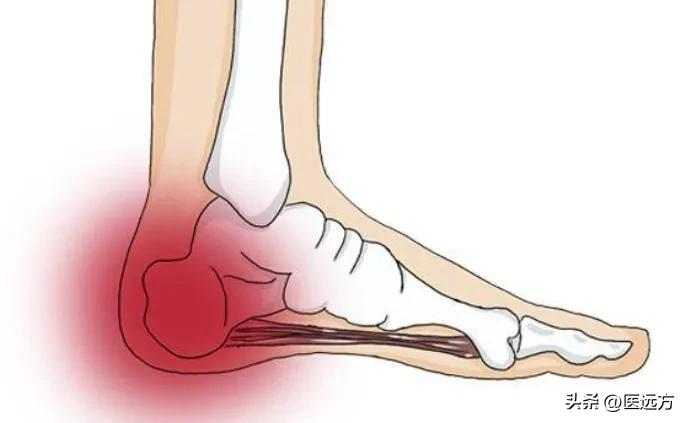 风湿补钙有用吗(风湿补钙有什么好处)-硒宝网