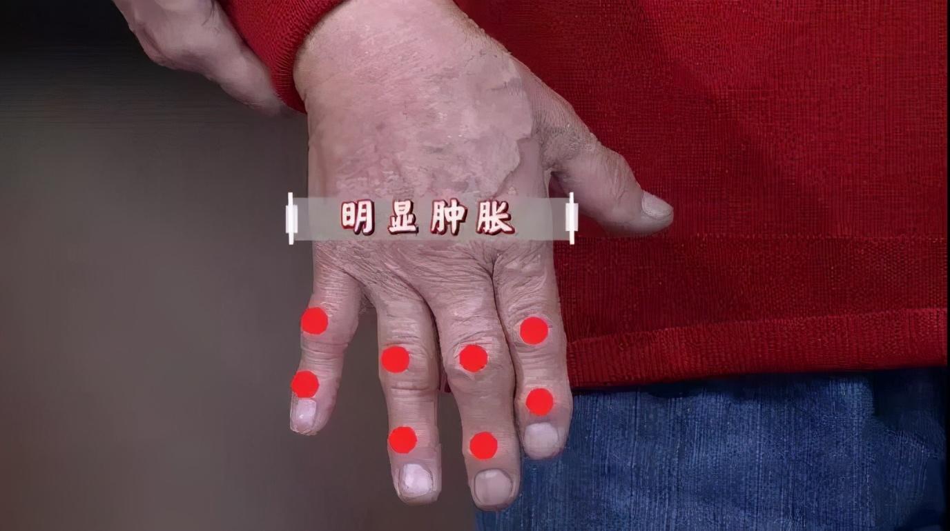 风湿补钙有用吗（风湿补钙用有效果吗）-硒宝网