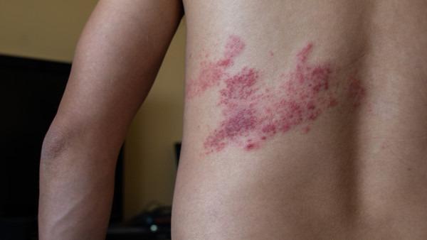 锌硒宝片治疗痤疮(锌痤疮)-硒宝网