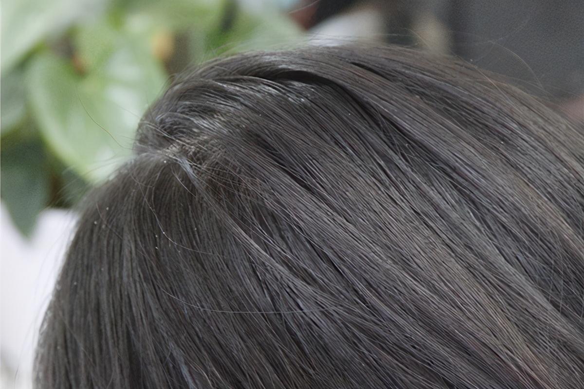 白头发是缺什么微量元素(缺什么微量元素头发白)-硒宝网