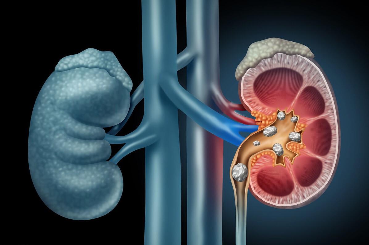 肾结石可以补钙吗(肾结石补钙可以用哪种钙片儿)-硒宝网