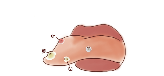 口疮喝锌硒宝行吗(锌硒片治疗口腔溃疡)-硒宝网