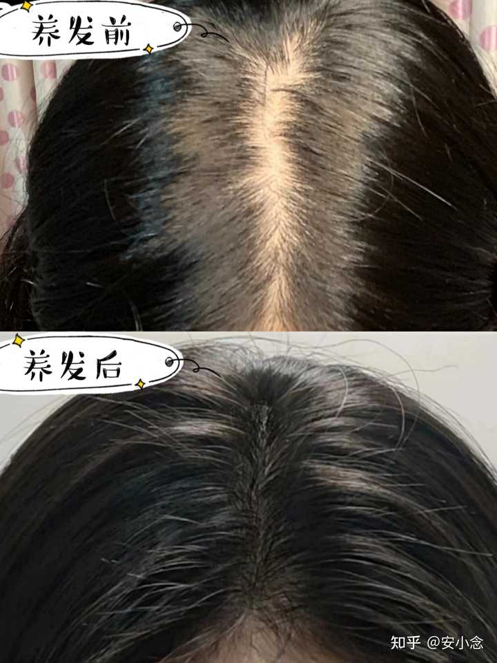 脱发补锌有用吗（脱发补锌用有什么好处）-硒宝网