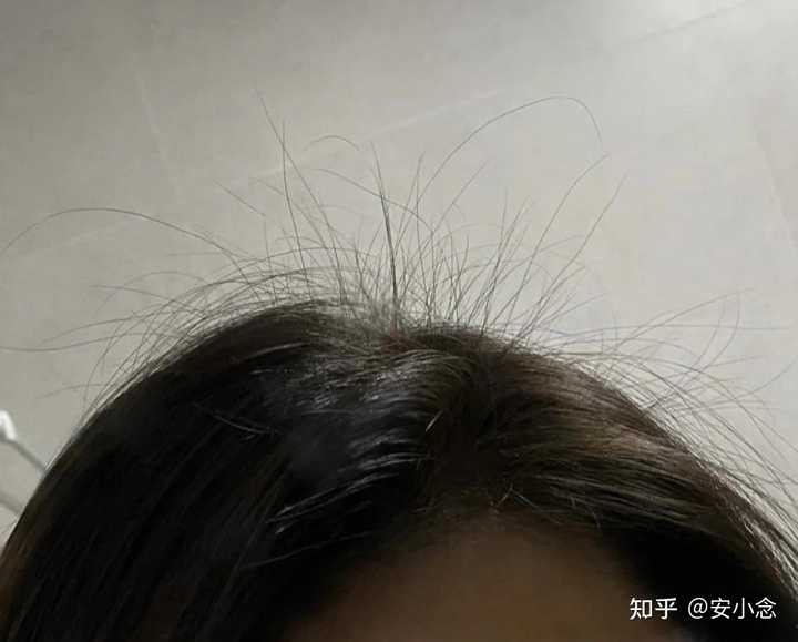 脱发补锌有用吗（脱发补锌用有什么好处）-硒宝网