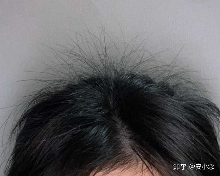 脱发补锌有用吗（脱发补锌用有什么好处）-硒宝网